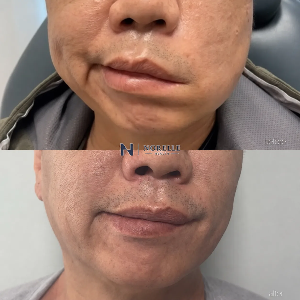 Before and after photographs of a facial paralysis patient showing improved lower face balance