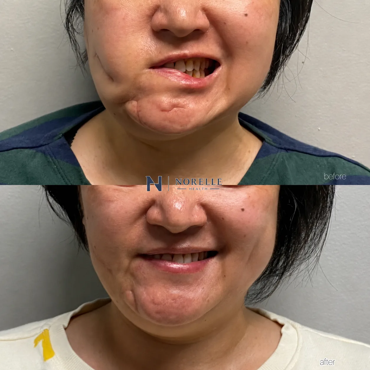 Before and after photographs of a facial paralysis patient showing improved smile after reanimation treatment