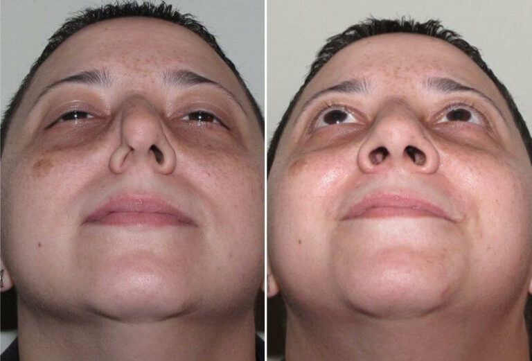 Purpose of Alar Batten Grafts