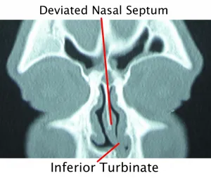 Deviated Septum